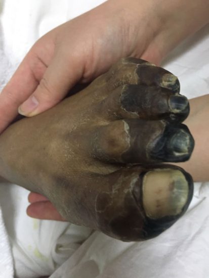 男子行心臟主動脈瓣置換術花費180萬元引質疑