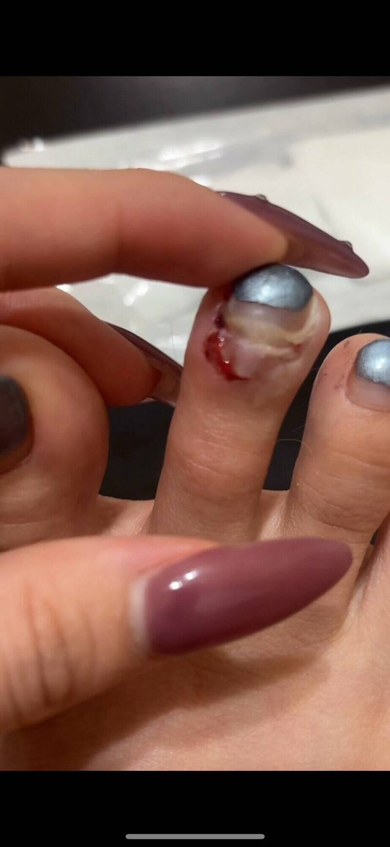 新竹市王小姐骑YouBike遭恶霸犬攻击咬断脚趾甲，向饲主求偿15万，未获诚意回应，决定提告捍卫权益。（王小姐提供）