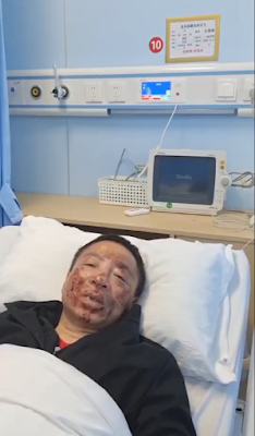 江苏无锡维权人士沈爱斌在派出所遭警察殴打，鼻梁骨折