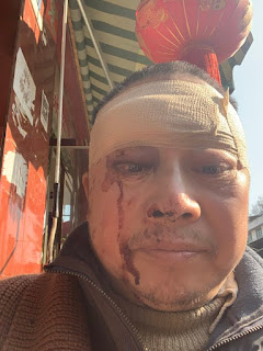 四川成都人權捍衛者、秋雨教會會友陳雲飛遭暴徒襲擊 面部多處受傷 傷口縫了四針