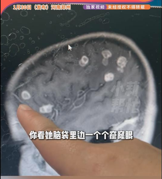 河南6岁女孩脑子被“啃”20个洞 原因竟是…