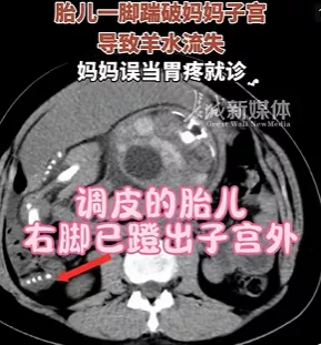 “魔童降世”，杭州一孕35周妈妈被胎儿踢破子宫误当胃疼