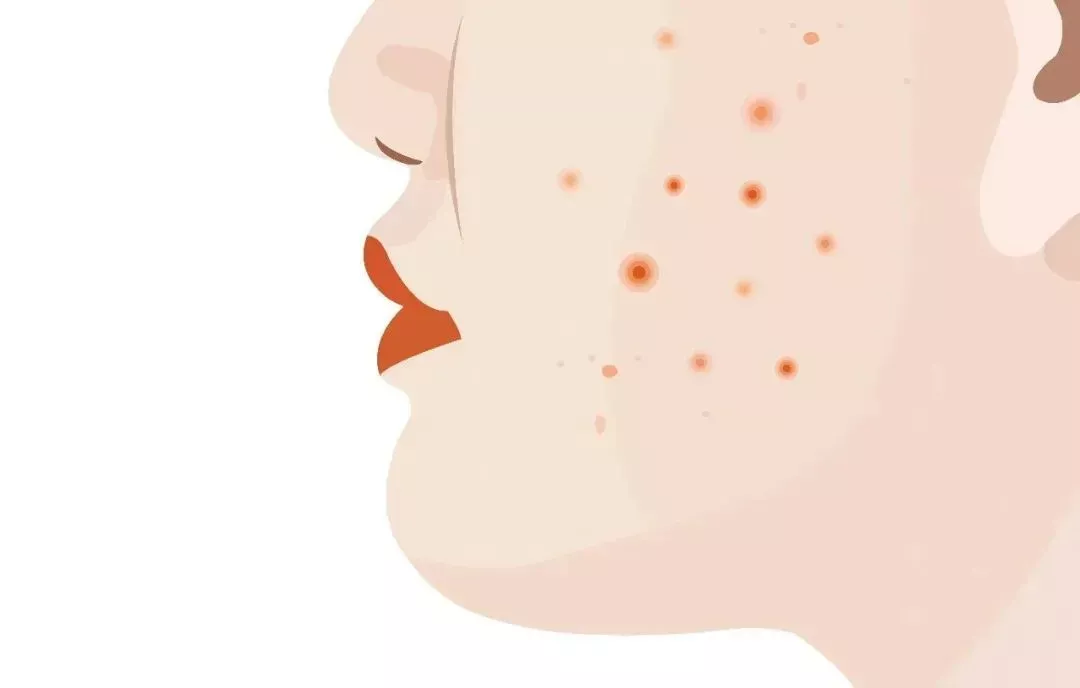 可能影响性功能的“祛痘神药”，很多人在滥用