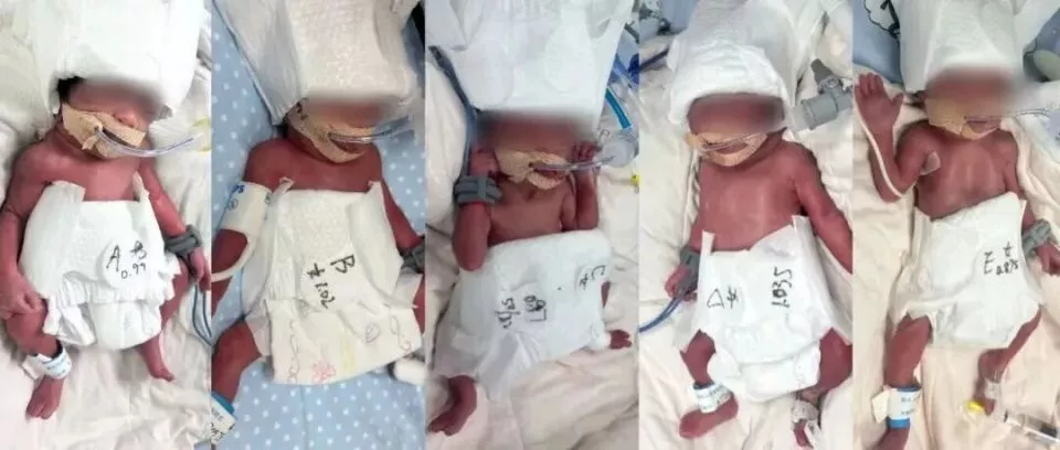 24岁产妇凌晨生下5胞胎（1男4女），最重1030克