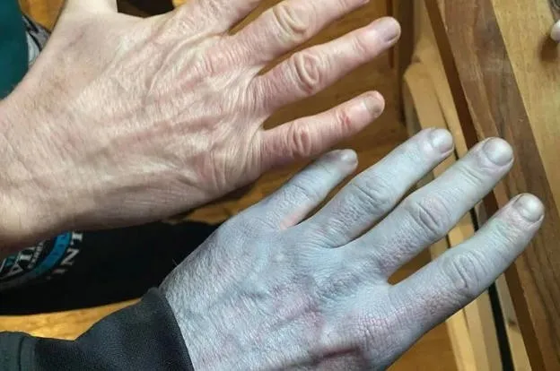 他全身发蓝，被紧急送医！真相曝光 网民惊呆