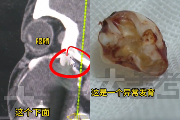 ▲目前已成功拔除。 (图/翻摄自微博)