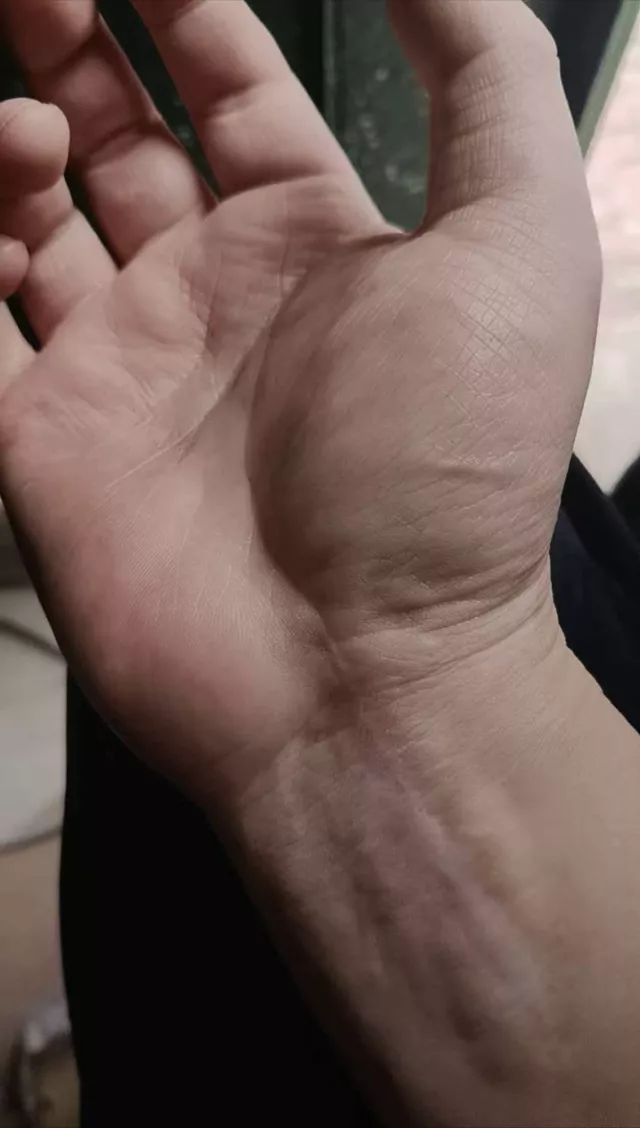 74页病历被修改30次 男子做骨折手术 神经损伤