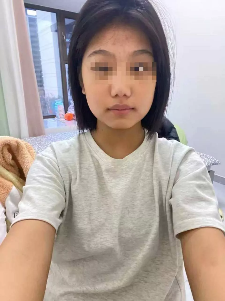 山东16岁女子全身90%烧伤：家属筹款，嫌疑人被批捕